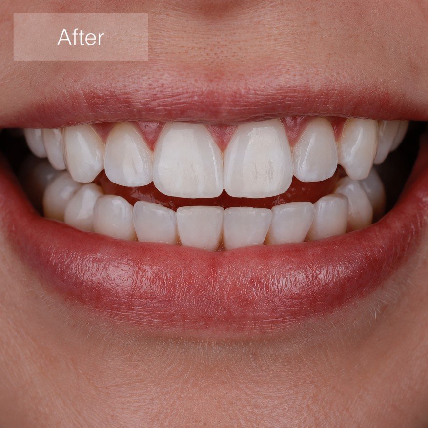 After — Invisalign consultation at Tsawwassen Commons Dental Centre
