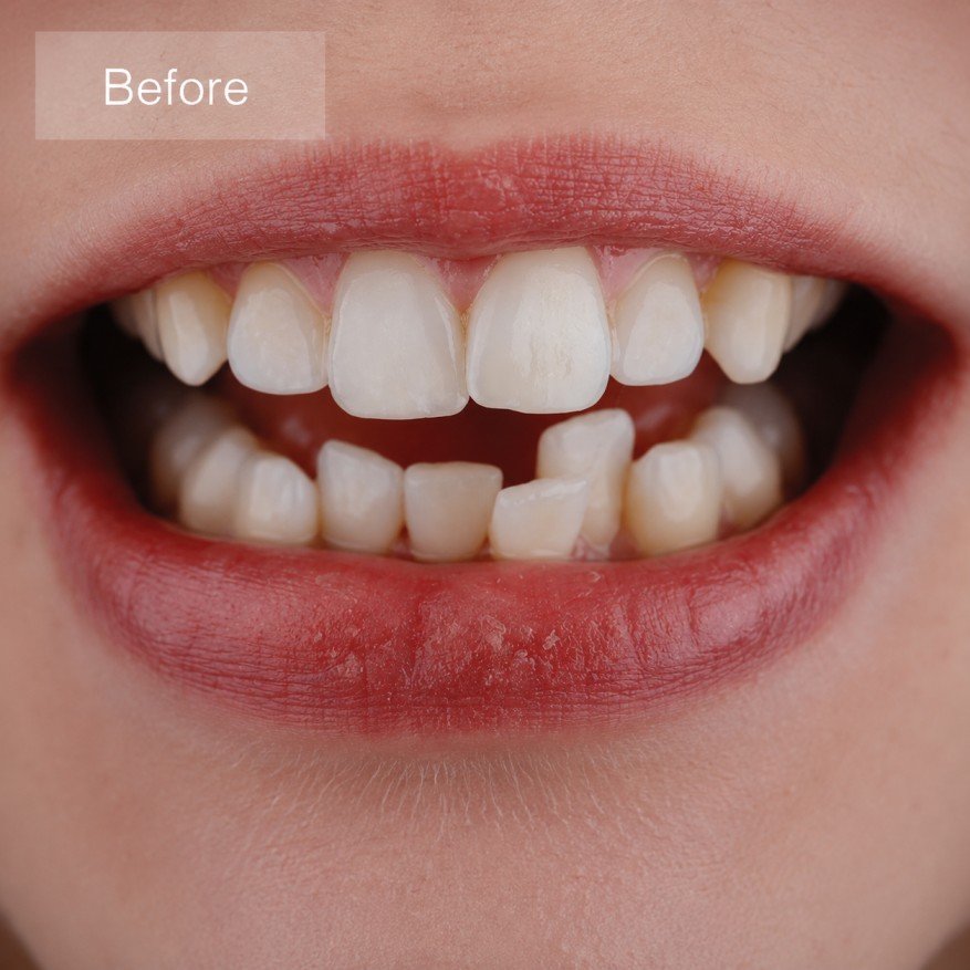 Before — Invisalign consultation at Tsawwassen Commons Dental Centre