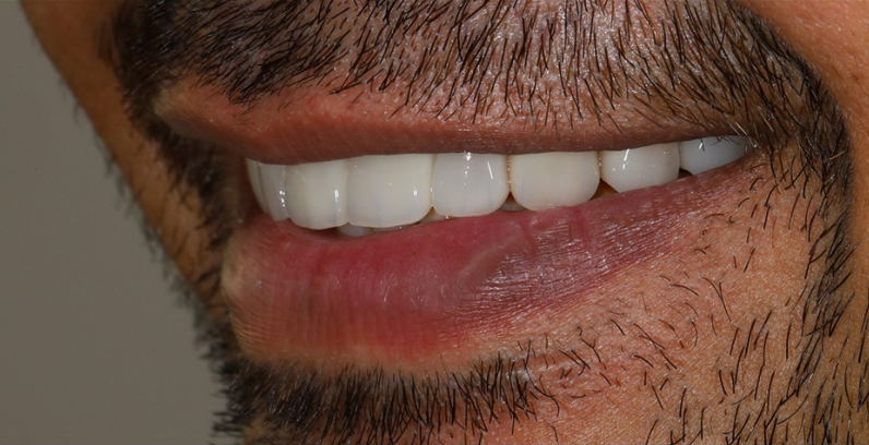 After — complete oral care at Tsawwassen Commons Dental Centre