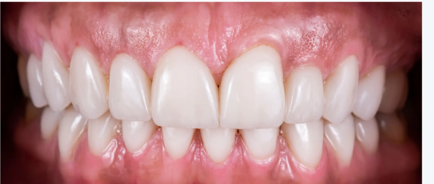 After — teeth cleaning and polishing at Tsawwassen Commons Dental Centre