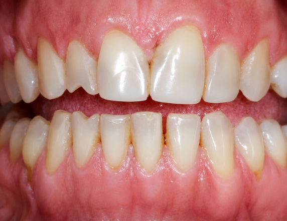 Before — teeth cleaning and polishing at Tsawwassen Commons Dental Centre