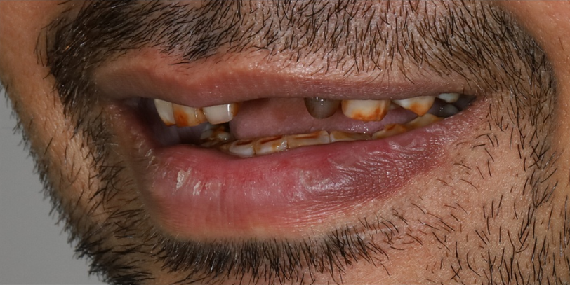 Before — complete oral care at Tsawwassen Commons Dental Centre